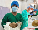 बिरामीको मूत्रथैलीबाट ३.१ किलोको पथरी निकालियो_img