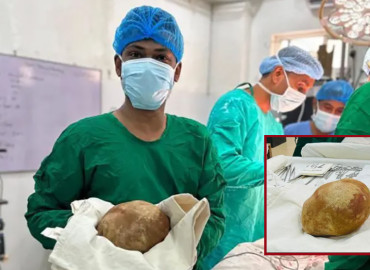 बिरामीको मूत्रथैलीबाट ३.१ किलोको पथरी निकालियो