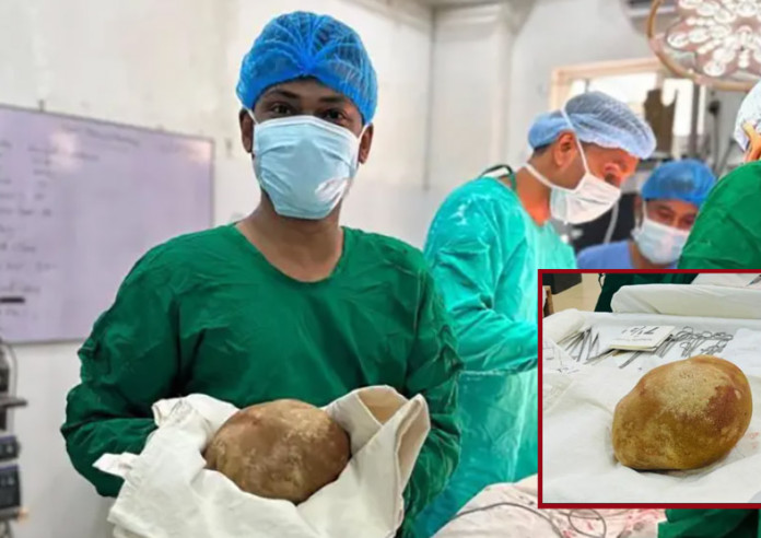 बिरामीको मूत्रथैलीबाट ३.१ किलोको पथरी निकालियो